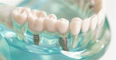 what are fake tooth called